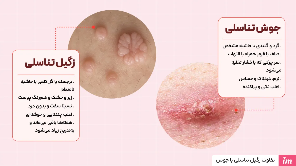 فرق زگیل تناسلی با جوش