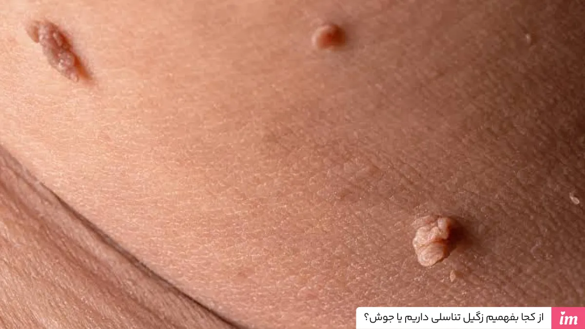 از کجا بفهمیم زگیل تناسلی داریم یا جوش