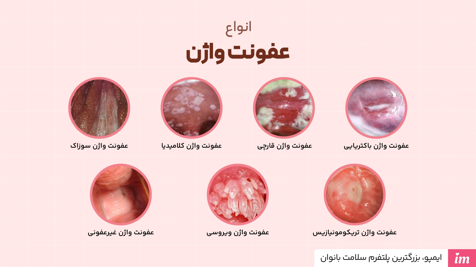 عکس انواع عفونت واژن